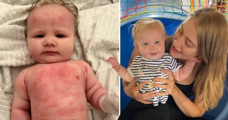 Mum finds £7.99 solution to baby’s severe eczema that made her ‘claw’ at her skin until she bled
