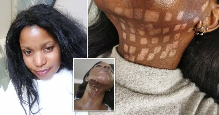 Woman left with ‘chessboard burns’ after botched laser hair removal