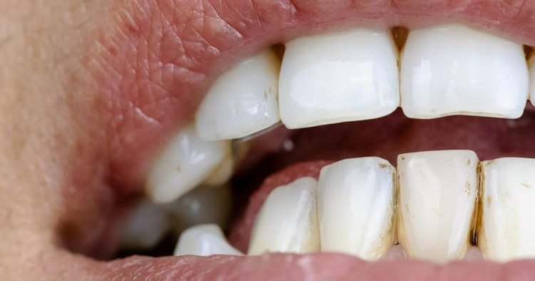 If you have black triangles between your teeth, here’s why