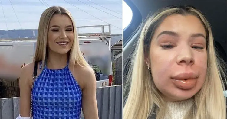 Woman’s face inflated like a balloon after lip filler dissolved